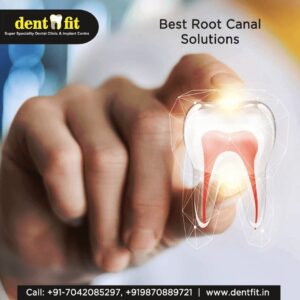 Dentfit-root-canal